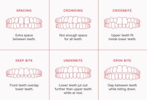 Candid Pro Clear Aligners - 3D digital images