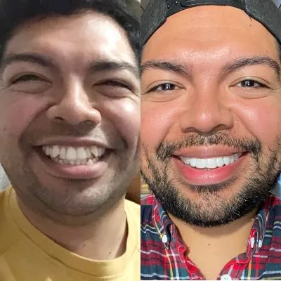 Candid Pro Clear Aligners  before and after