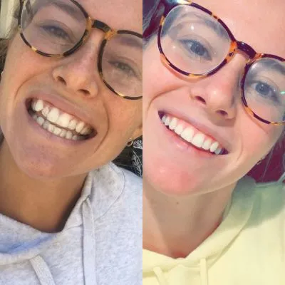 Candid Pro Clear Aligners  before and after
