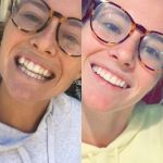 Candid Pro Clear Aligners  before and after