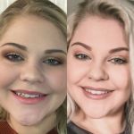Candid Pro Clear Aligners  before and after