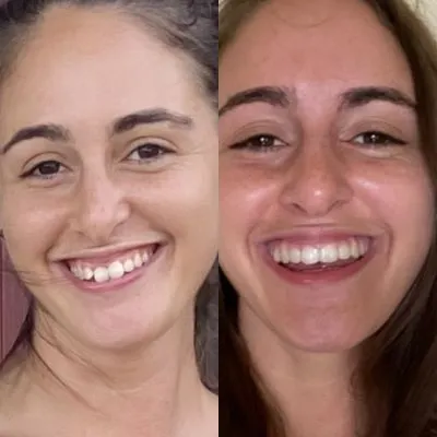 Candid Pro Clear Aligners  before and after