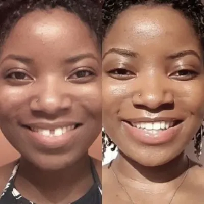 Candid Pro Clear Aligners  before and after