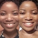 Candid Pro Clear Aligners  before and after